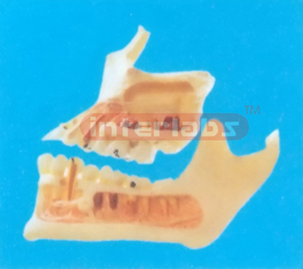 DISEASE MODEL FOR HALF OF THE UPPER AND LOWER JAW